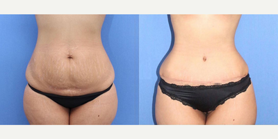 Case 1288 - Woman treated with Tummy Tuck