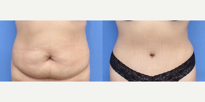 Case 1289 - Woman treated with Tummy Tuck