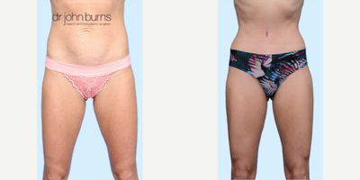 Case 129 - Woman treated with Tummy Tuck