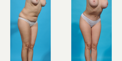 Case 1295 - 35-44 year old woman treated with Abdominal Etching, Diastasis Recti Repair, Drainless Tummy Tuck, Laser Liposuction, Liposculpt