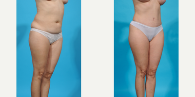 Case 1296 - 35-44 year old woman treated with Abdominal Etching, Diastasis Recti Repair, Drainless Tummy Tuck, Laser Liposuction, Liposculpt