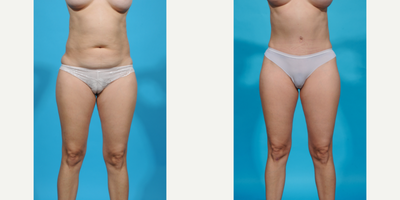 Case 1297 - 35-44 year old woman treated with Abdominal Etching, Diastasis Recti Repair, Drainless Tummy Tuck, Laser Liposuction, Liposculpt