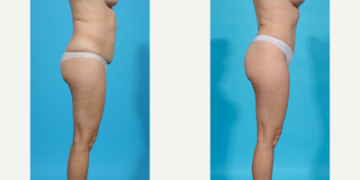 Case 1299 - 35-44 year old woman treated with Abdominal Etching, Diastasis Recti Repair, Drainless Tummy Tuck, Laser Liposuction, Liposculpt