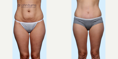 Case 130 - Woman treated with Tummy Tuck