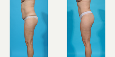 Case 1300 - 35-44 year old woman treated with Abdominal Etching, Diastasis Recti Repair, Drainless Tummy Tuck, Laser Liposuction, Liposculpt