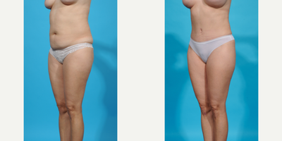 Case 1301 - 35-44 year old woman treated with Abdominal Etching, Diastasis Recti Repair, Drainless Tummy Tuck, Laser Liposuction, Liposculpt