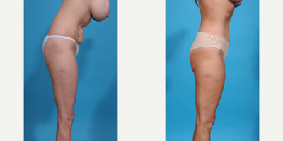 Case 1302 - 35-44 year old woman treated with Abdominal Etching, Diastasis Recti Repair, Drainless Tummy Tuck, Liposculpture, Liposuction, M