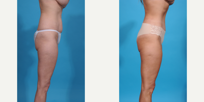 Case 1303 - 35-44 year old woman treated with Abdominal Etching, Diastasis Recti Repair, Drainless Tummy Tuck, Liposculpture, Liposuction, M