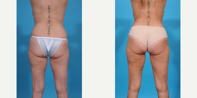 Case 1304 - 35-44 year old woman treated with Abdominal Etching, Diastasis Recti Repair, Drainless Tummy Tuck, Liposculpture, Liposuction, M