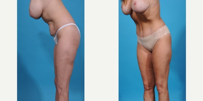 Case 1305 - 35-44 year old woman treated with Abdominal Etching, Diastasis Recti Repair, Drainless Tummy Tuck, Liposculpture, Liposuction, M