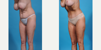 Case 1307 - 35-44 year old woman treated with Abdominal Etching, Diastasis Recti Repair, Drainless Tummy Tuck, Liposculpture, Liposuction, M