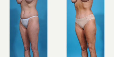 Case 1308 - 35-44 year old woman treated with Abdominal Etching, Diastasis Recti Repair, Drainless Tummy Tuck, Liposculpture, Liposuction, M