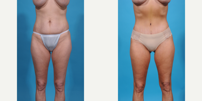 Case 1309 - 35-44 year old woman treated with Abdominal Etching, Diastasis Recti Repair, Drainless Tummy Tuck, Liposculpture, Liposuction, M