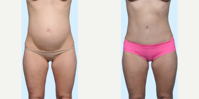 Case 131 - Woman treated with Tummy Tuck