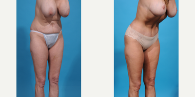 Case 1310 - 35-44 year old woman treated with Abdominal Etching, Diastasis Recti Repair, Drainless Tummy Tuck, Liposculpture, Liposuction, M