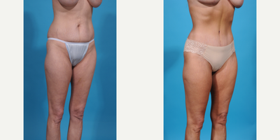 Case 1311 - 35-44 year old woman treated with Abdominal Etching, Diastasis Recti Repair, Drainless Tummy Tuck, Liposculpture, Liposuction, M