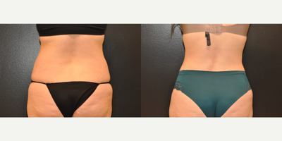 Case 1312 - 25-34 year old woman treated with Tummy Tuck