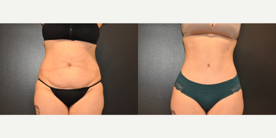 Case 1313 - 25-34 year old woman treated with Tummy Tuck