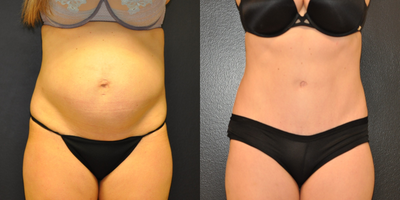 Case 1314 - 35-44 year old woman treated with Tummy Tuck