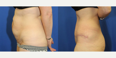 Case 1315 - Woman treated with Tummy Tuck