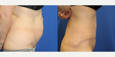 Case 1316 - Woman treated with Tummy Tuck