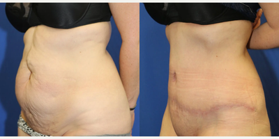 Case 1317 - Woman treated with Tummy Tuck