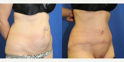 Case 1318 - Woman treated with Tummy Tuck