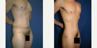 Case 1319 - 45-54 year old Man treated with Tummy Tuck