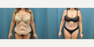 Case 132 - Woman treated with Tummy Tuck