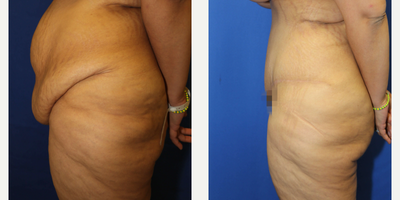 Case 1321 - Woman treated with Tummy Tuck