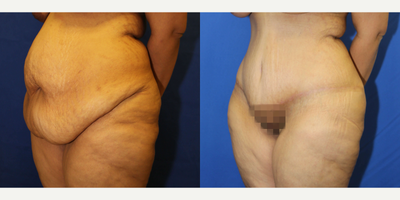 Case 1322 - Woman treated with Tummy Tuck