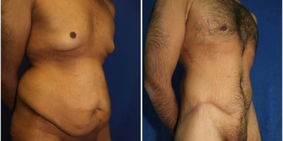 Case 1323 - Man treated with Tummy Tuck