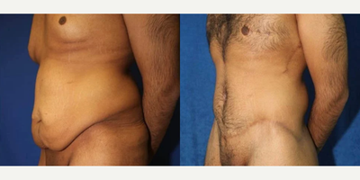 Case 1324 - Man treated with Tummy Tuck