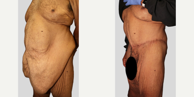 Case 1325 - Man treated with Tummy Tuck