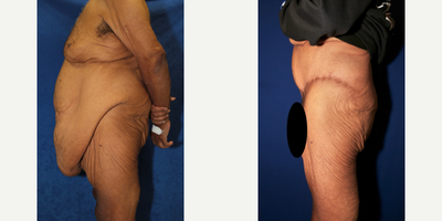 Case 1326 - Man treated with Tummy Tuck