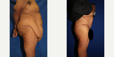 Case 1327 - Man treated with Tummy Tuck