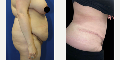 Case 1328 - Woman treated with Tummy Tuck