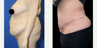 Case 1329 - Woman treated with Tummy Tuck