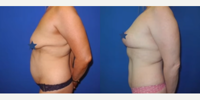 Case 1332 - Woman treated with Mommy Makeover, Tummy Tuck, Breast Lift