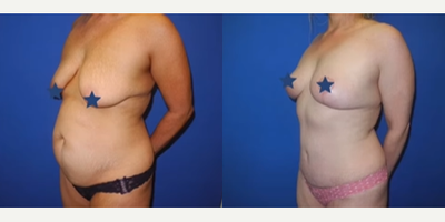 Case 1333 - Woman treated with Mommy Makeover, Tummy Tuck, Breast Lift