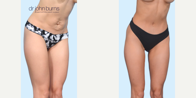 Case 1345 - Woman treated with Tummy Tuck