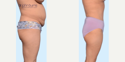 Case 1346 - Woman treated with Tummy Tuck