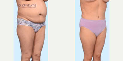 Case 1347 - Woman treated with Tummy Tuck