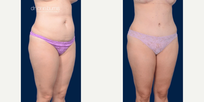 Case 1348 - Woman treated with Tummy Tuck