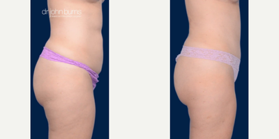 Case 1349 - Woman treated with Tummy Tuck