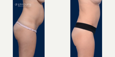 Case 1350 - Woman treated with Tummy Tuck