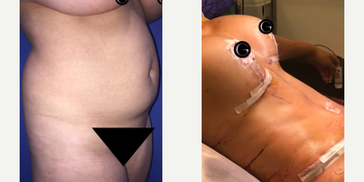 Case 1352 - Woman treated with Tummy Tuck, Mommy Makeover