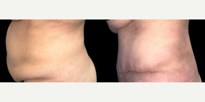 Case 1353 - Woman treated with Tummy Tuck