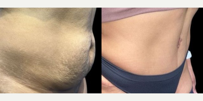 Case 1354 - Woman treated with Tummy Tuck