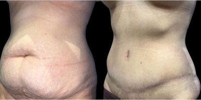 Case 1355 - Woman treated with Tummy Tuck